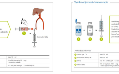 EmboCept® S – univerzální krátkodobá embolizace